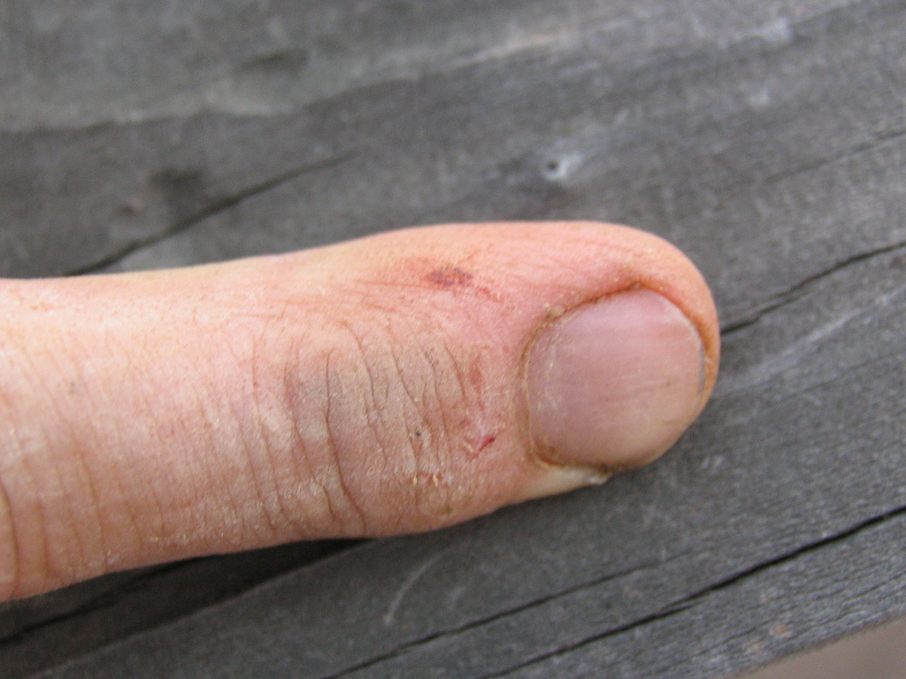 Tarantula bite